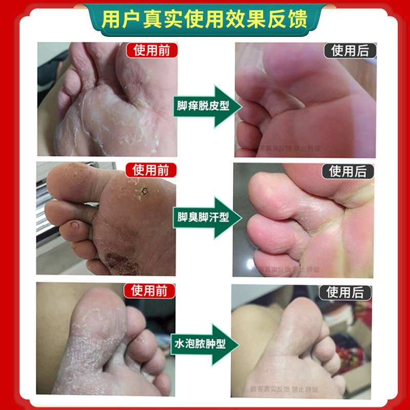 金泰康旗舰店脚臭粉脚汗泡脚中药包去真菌脚气止汗除臭喷雾脚痒水泡脱皮烂脚丫2