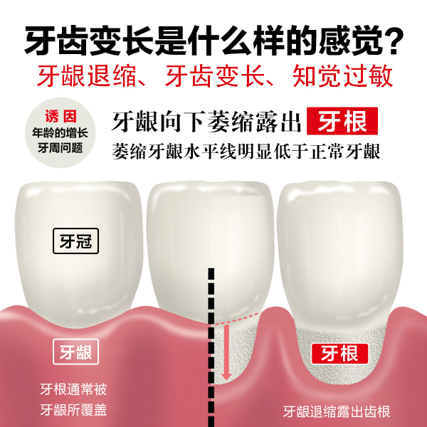 日本进口狮王防根龋牙膏楔状缺损牙根暴露敏感抗敏脱敏含氟防蛀牙