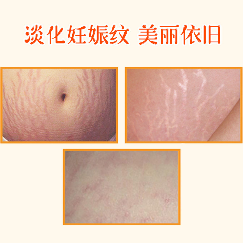 bio oil百洛200ml产前产后预防油 天瑞母婴妊娠纹护理