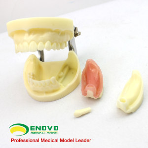 ENOVO颐诺齿科口腔种植模型 齿科外科学 教学模型牙颌牙医种植执业考 口腔教学种植实训模型医学院校教学培训