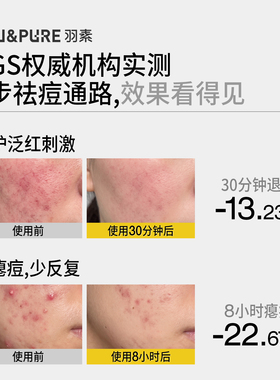 羽素大灯泡祛痘舒红面部精华液