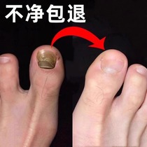 (Tongrentang hot sell 100 thousand) not covered with no drop a drop of painless removal of the hands toe bad potassium does not hurt potassium