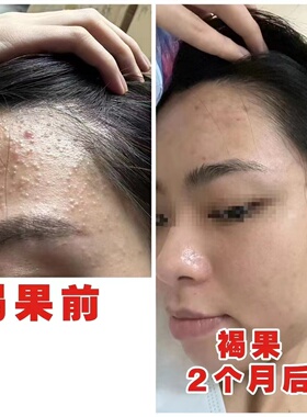 台湾进口温和止痒控痘精油霜红肿过敏婴幼儿蚊虫咬可擦长期痘痘