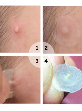 BREYLEE acne treatment patches 茶树精华贴痘痘夜用贴