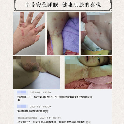 疥虱康宁专攻疥疮膏结节红疹晚上皮肤痒专用去疥螨疥虫虫卵满力净 - 图1