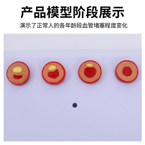 教学仿真人体病理血管堵塞动支脉粥样硬化心血管模型堵塞程度变化 - 图1