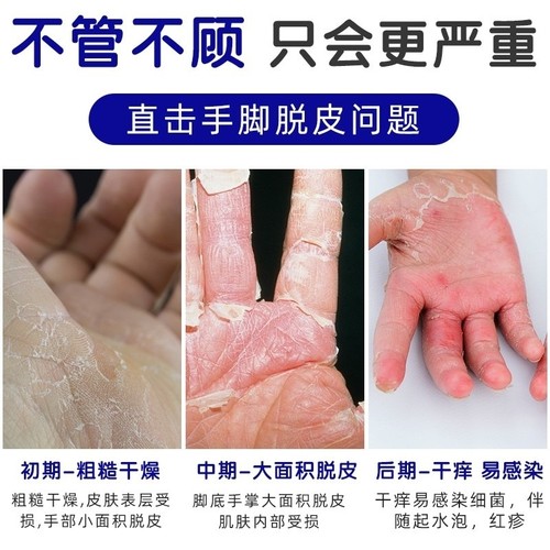现货速发手指缝溃烂手丫手指烂手丫药膏溃烂手指发红脱皮手丫烂杀 - 图1