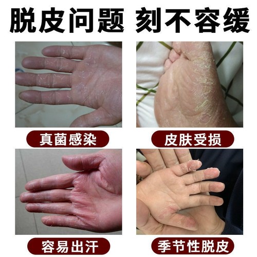 现货速发手指缝溃烂手丫手指烂手丫药膏溃烂手指发红脱皮手丫烂杀 - 图0