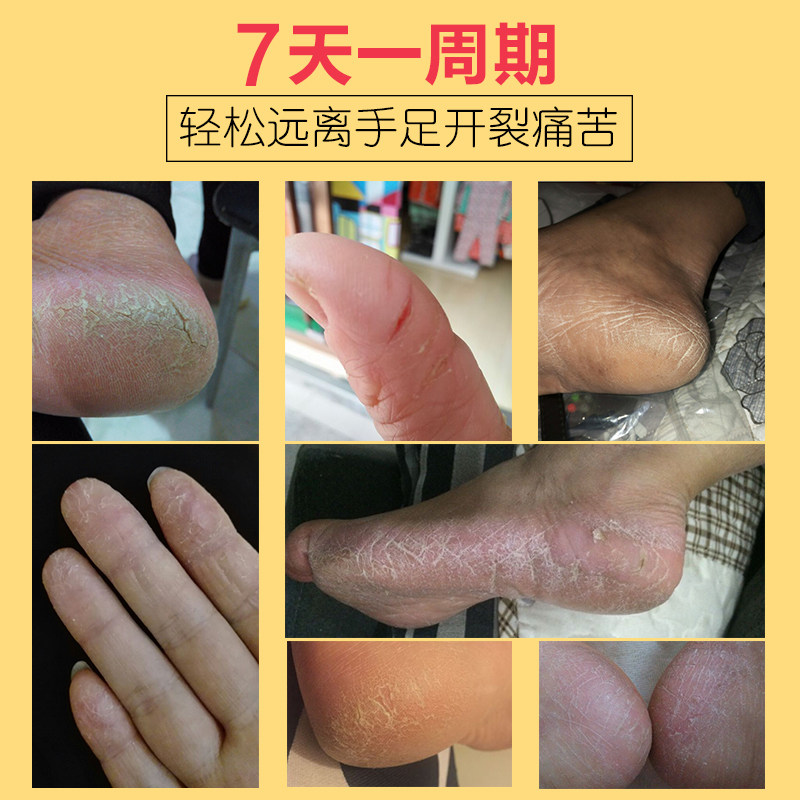 脚后跟干裂手足防裂皲裂手脚跟膏 金泰康铃医护手霜