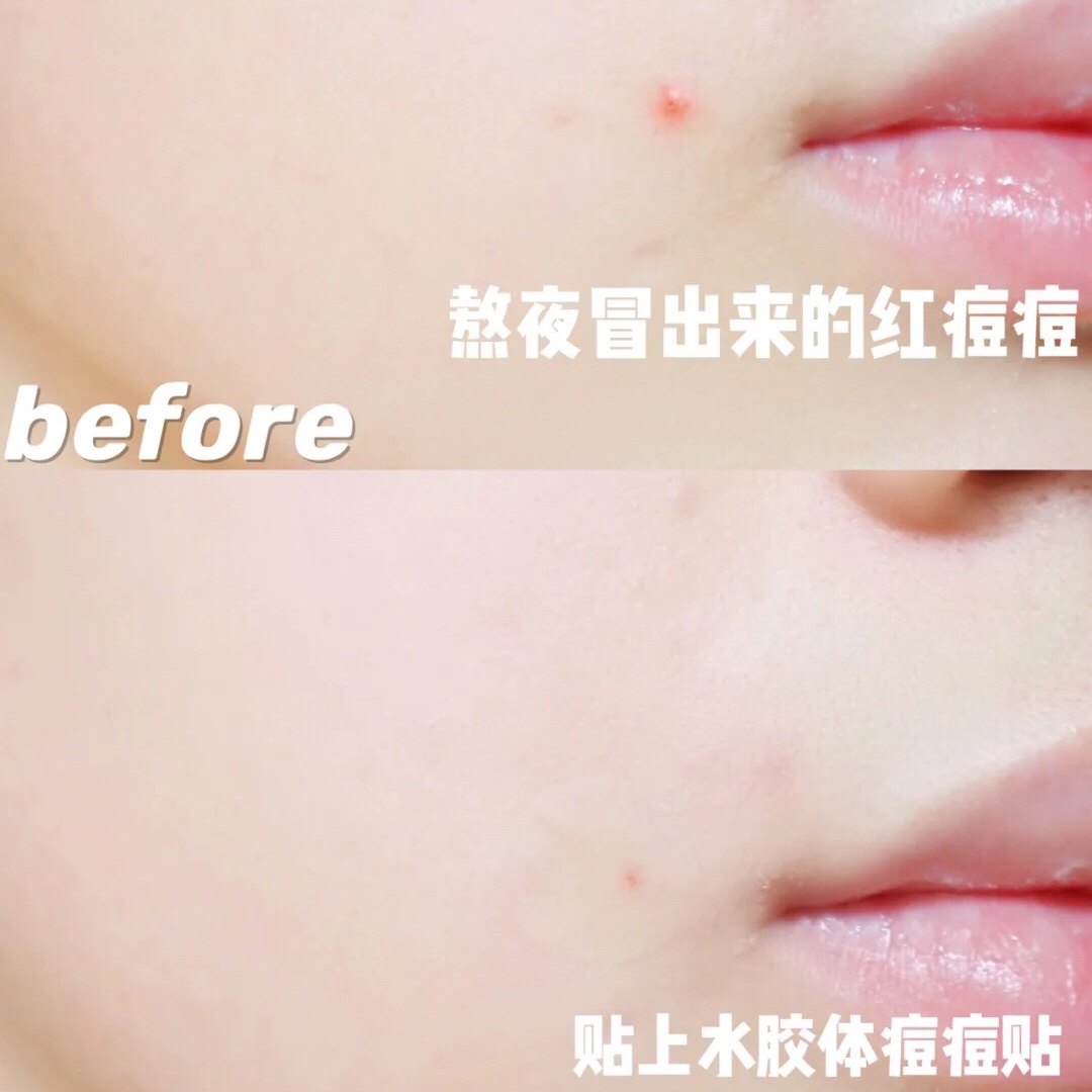 灭痘不留印 隐形款~舒家水胶体痘痘贴0.1mm超薄痘痘创口贴24枚,淘宝优惠券,粉丝福利购,淘宝优惠卷