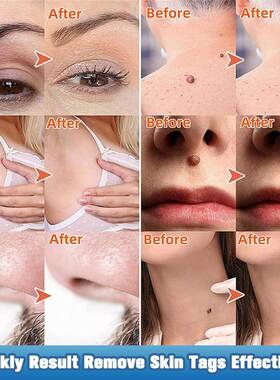 Skin Tag Removal Serum Warts Remover Pen 7Days Painless Papi