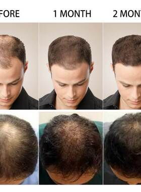 Sevich Hair Growth Spray Serum Ginger Anti Hair Loss Fast Gr