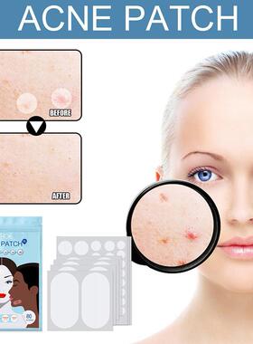 80pcs/Set Acne Acne Patch Large Size Acne Patch Hydrocolloid
