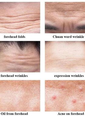 Anti-wrinkle Forehead Line Removal Gel Patch Firming Mask Fr