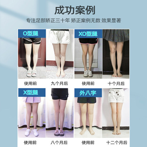 矫正鞋垫神器儿童成人o型腿外翻足内翻x型小腿xo内外八字ox腿型 - 图3