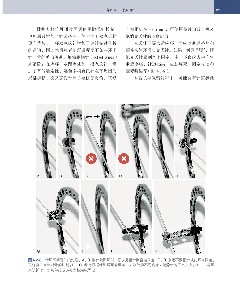 正版 Ilizarov外固定器械方法和理念朱跃良郑学建著北京大学医学出版社基本原理基本部件胫骨横向搬移和相关技术-图1