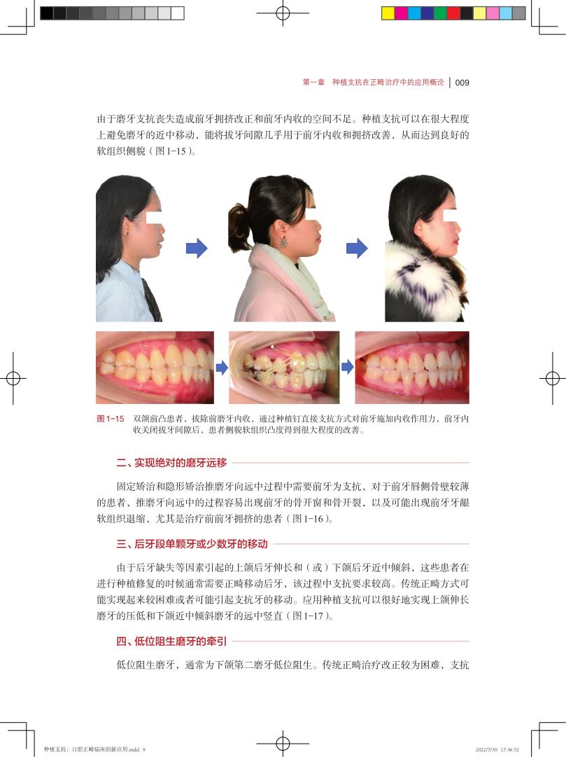 种植支抗在正畸治疗中的创新应用 临床口腔科学 图文并茂阐述种植支抗植入步骤和植入技巧的专著 龙虎 韩向龙 上海科学技术出版社 - 图2