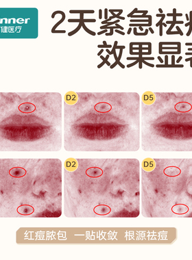 稳健痘痘贴水胶体敷料防水痘印