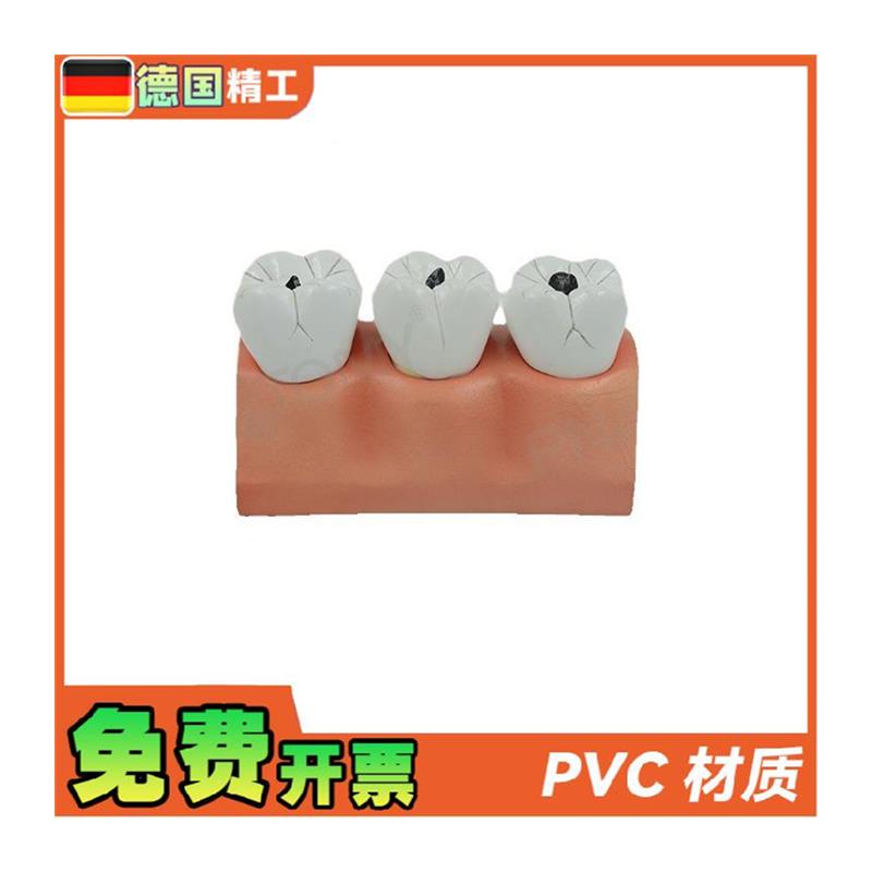 德国】牙科牙g齿龋齿解剖分解模型口腔科牙科病理蛀牙模型 教学展 - 图3