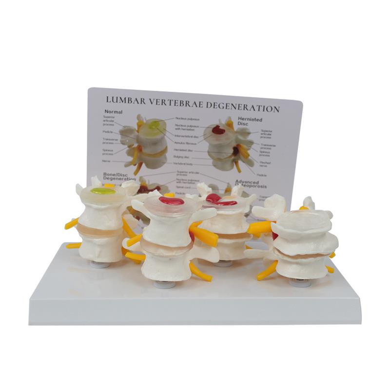 4阶段病态腰椎比较模型带背卡O骨科教学展示教具 - 图3