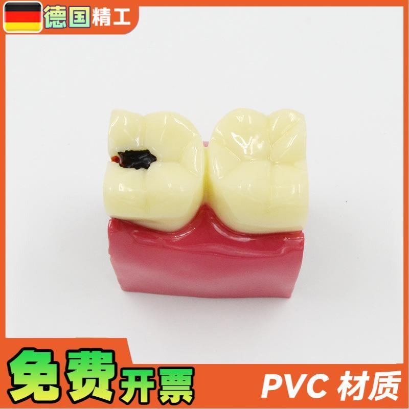 德国】六倍龋齿对比模q型口腔牙齿模型口腔教学蛀牙切面模型牙 - 图1