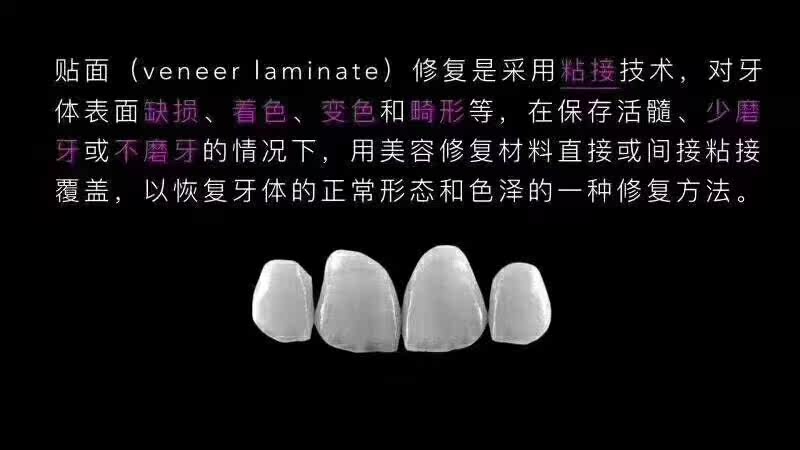 全瓷牙贴面冰瓷牙 逸之兴医疗器械6863口腔科材料