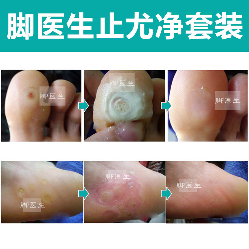 脚医生鸡眼膏贴去疣净去足部 庆大堂大药房足部健康