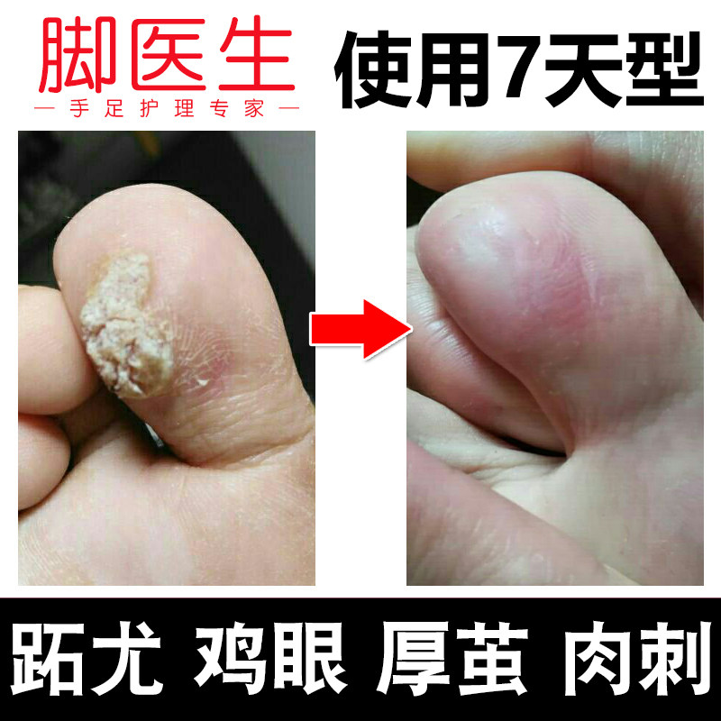 脚医生鸡眼膏贴去疣净去足部 庆大堂大药房足部健康
