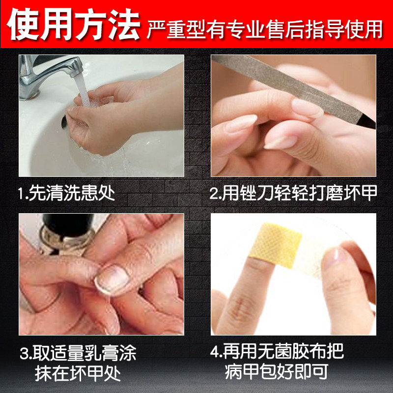 速攻辉之甲正品抗菌灰指甲抑菌乳膏 宝芝堂医疗器械保健理疗