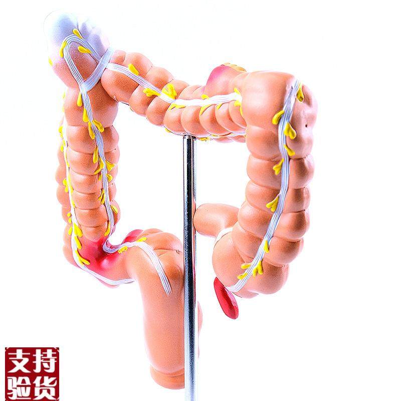 ENOVO颐诺h人体大肠疾病展示模型结肠直肠道病变症状消化系统疾病,淘宝优惠券,粉丝福利购,淘宝优惠卷