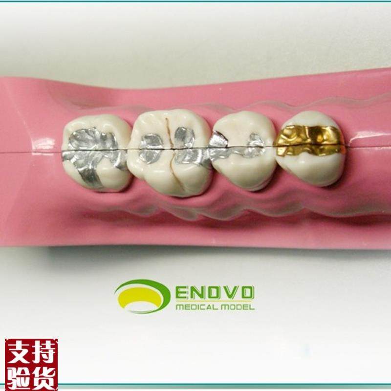 ENOVO颐诺右下后牙组织分解模型牙G齿解剖牙列模型口腔齿科科教学 - 图1