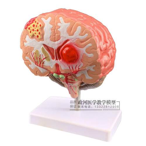 仿真人体脑部疾病模型大脑解剖神经内外科脑病理大Z脑病变模型 - 图0