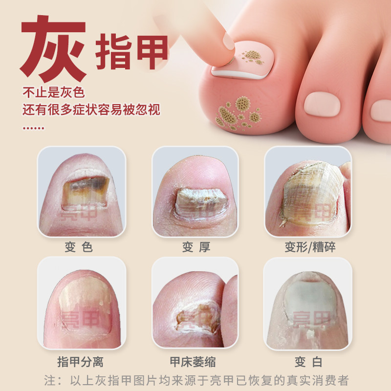 亮甲独特小红标复方聚维酮碘搽剂4ml*4灰指甲专用药效杀真菌正品,淘宝优惠券,粉丝福利购,淘宝优惠卷