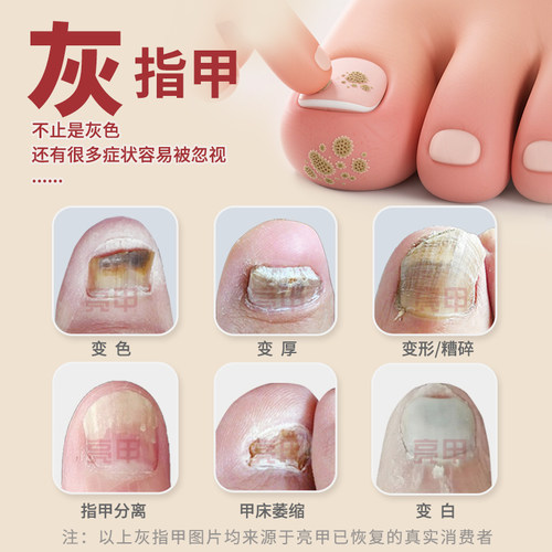 亮甲复方聚维酮碘搽剂4ml*4灰指甲专用药效杀真菌正品 - 图2