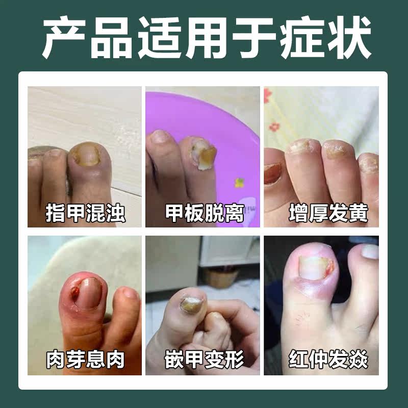 灰指甲抑菌液正品30灰指甲专用药 欣梵医疗器械保健理疗