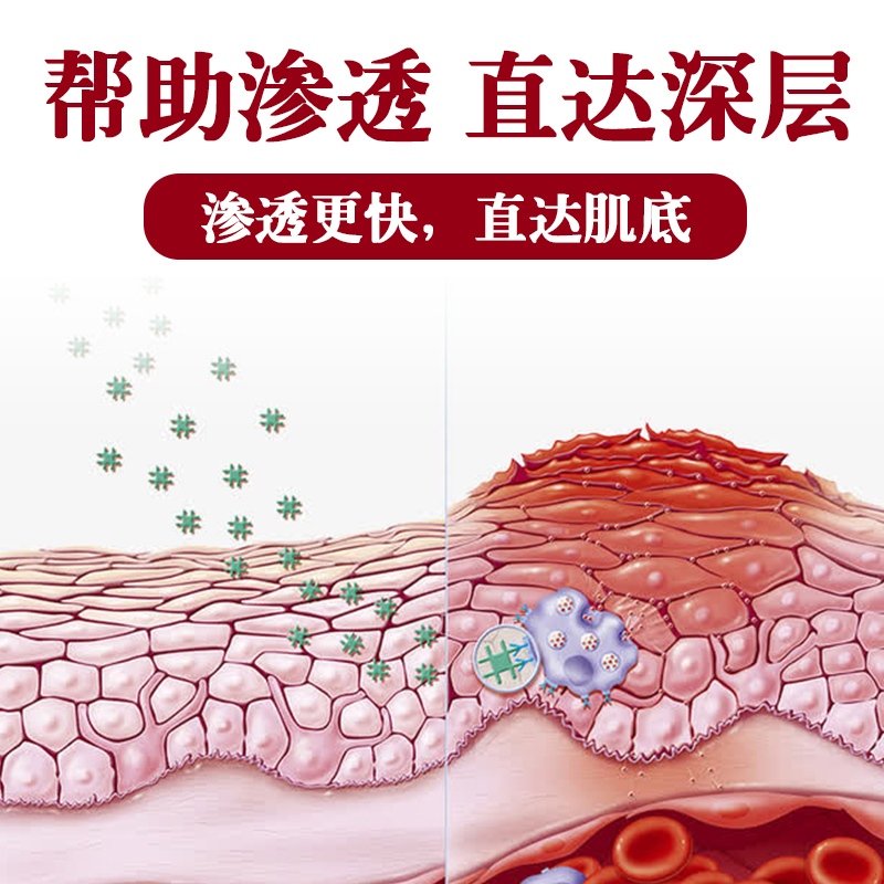 咽炎慢性咽炎除根咽喉炎异物感喉咙肿痛有痰扁桃体发炎咳嗽神器SW - 图2