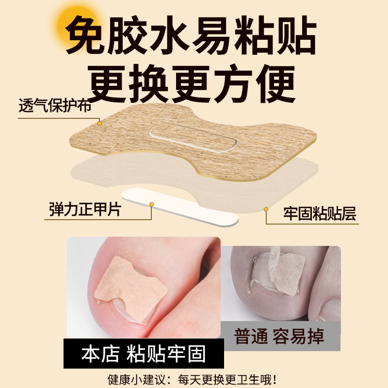 甲沟矫正器正甲贴脚指甲炎嵌甲工具专用指甲贴德国甲床趾甲固定器 - 图2