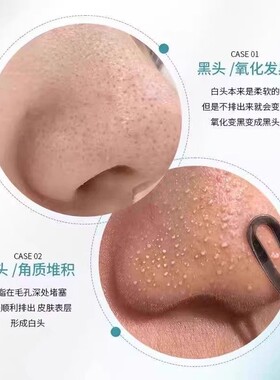 【官方正品】黑头导出液韩国进口黑头水控油去黑头粉刺深层清洁