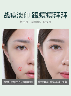 瑜然美芦荟胶正品保湿补水面霜祛痘痘贴晒修护痘印坑凝胶500g大瓶