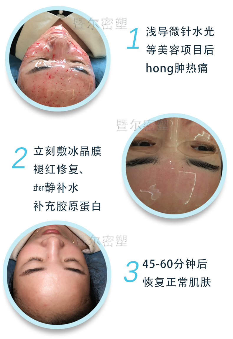 暨大修护冰晶膜1片创科美容院微针退红急救保湿舒缓补水冷敷贴 - 图1