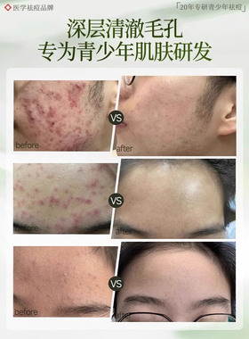 青少年洗面奶控油祛痘印黑头护肤