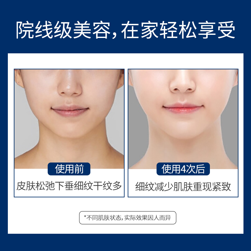 Omelon韩国HIFU超声波脸部提拉紧致刀抗皱法令纹皱纹家用美容仪