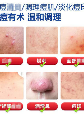 修正壬二酸植物祛痘凝胶去除淡化痘痘印粉刺修复闭口青春痘正品
