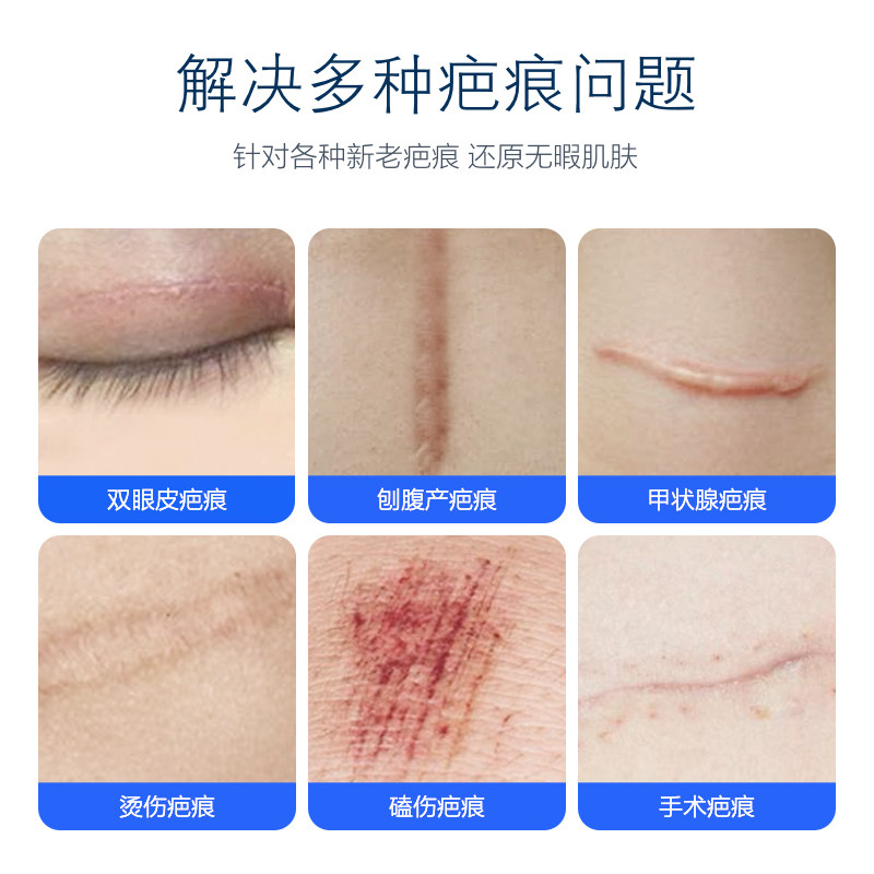 美国医用凹凸妊娠纹手术硅酮祛疤膏 健安堂医疗器械祛疤产品