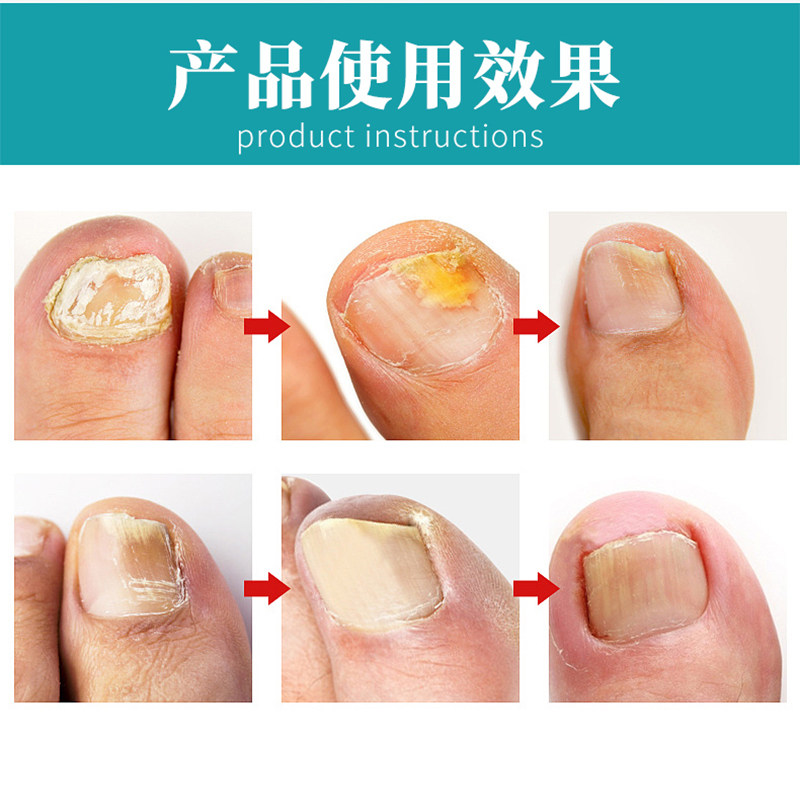 白云山灰指甲抑菌液30 tm专用冰醋酸 淮南药之都大药房保健理疗