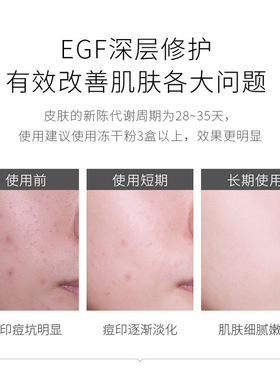 依卡茵修护冻干粉修复寡肽精华液痘痘淡化痘印坑面膜