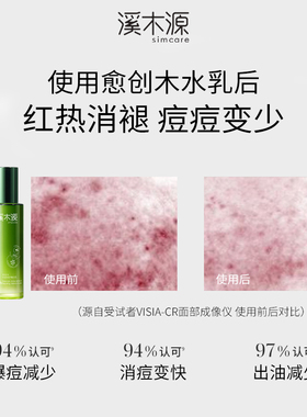 【百亿补贴】溪木源愈创木水乳无酸祛痘套装油痘敏感肌抑痘控油