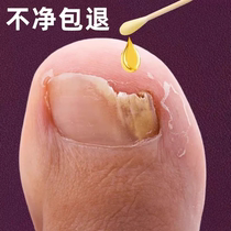 (Küchens hot selling) Drop a drop of bacteriostatic no-nail to remove 99% ash potassium fungus invalid packet withdrawal  