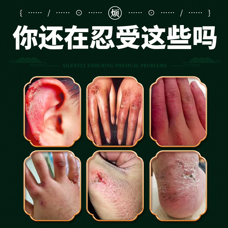 王泰林 冻疮膏 30g 天猫优惠券折后￥9.9包邮（￥19.9-10）