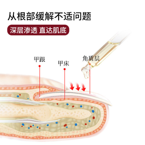 王泰林正品灰甲康护理液软甲脱甲沟脚气护理液 - 图1
